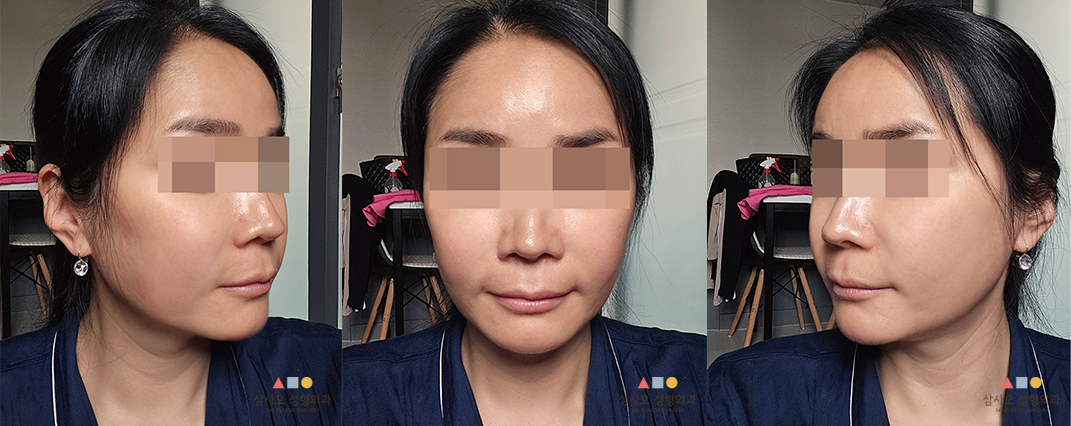 수술 후