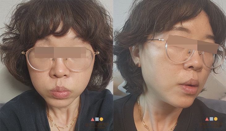 수술 후