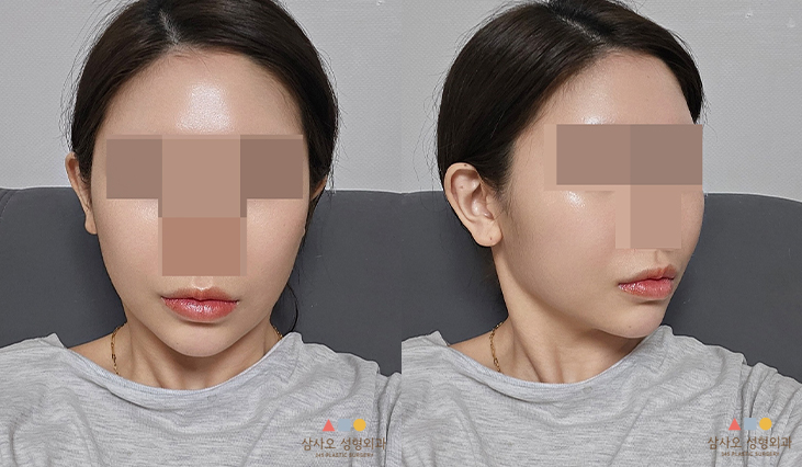 수술 후