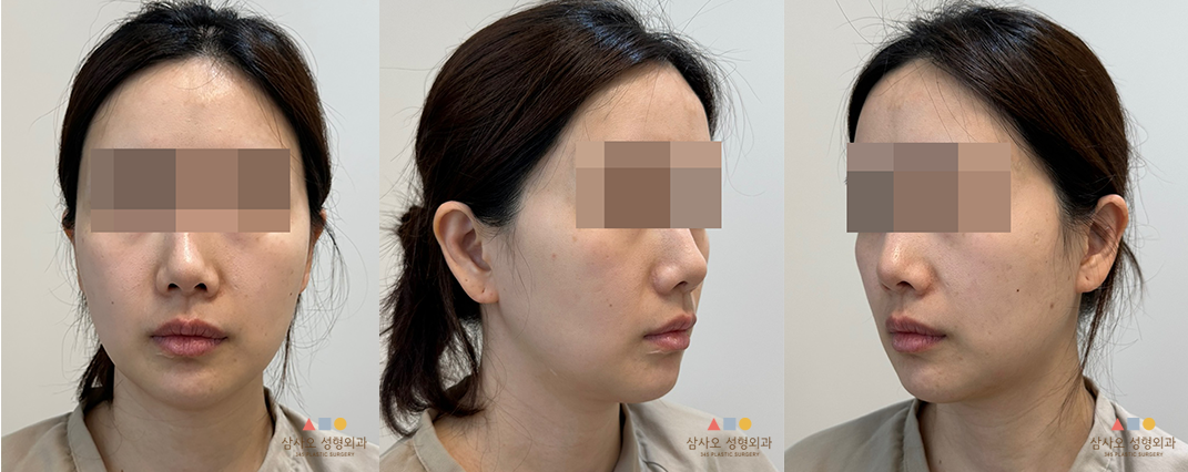 수술 전