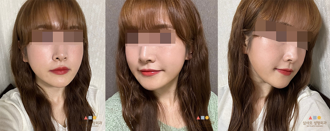 수술 후