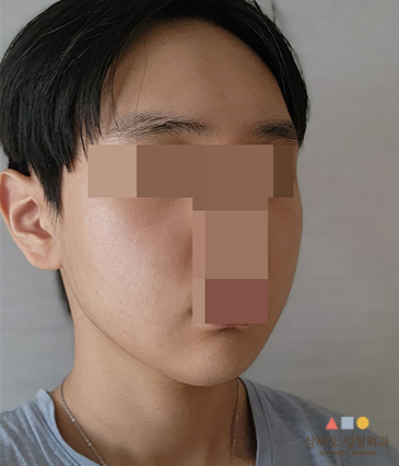 수술 후
