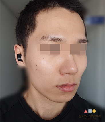 수술 전