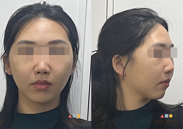 수술 후