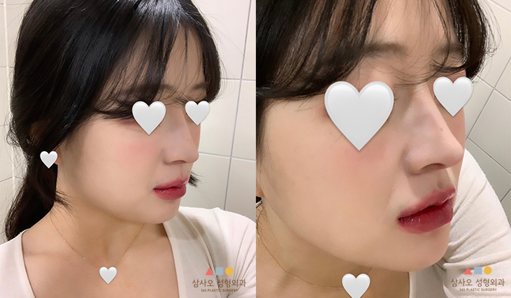 수술 후
