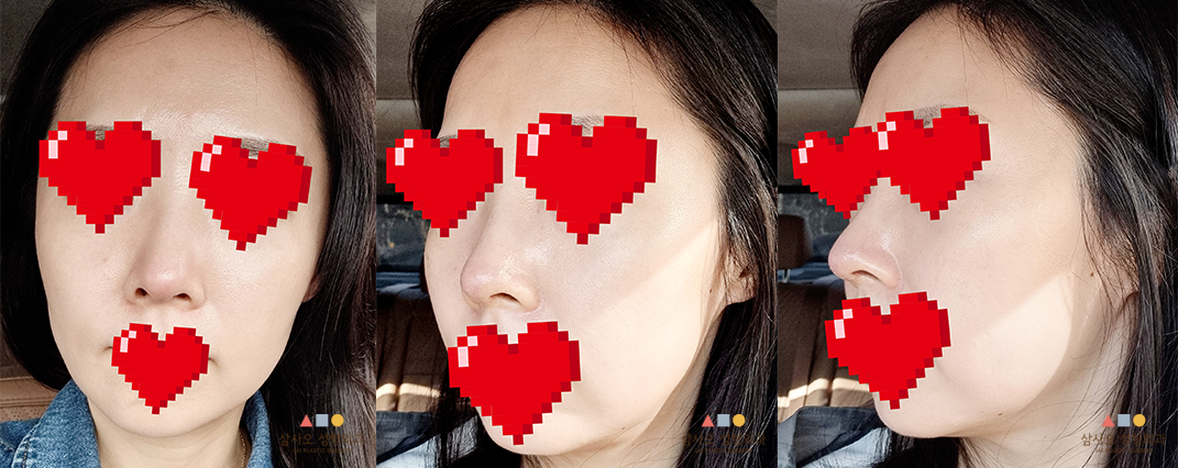 수술 후