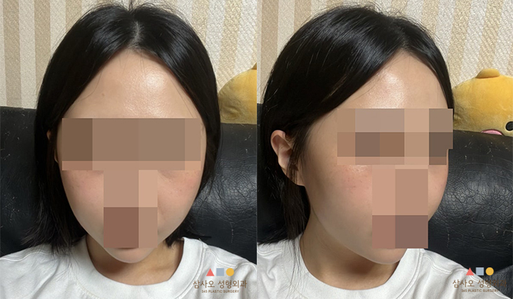 수술 후