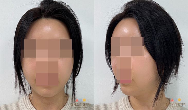 수술 후