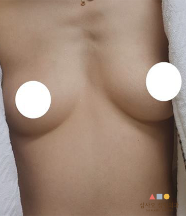 수술 전