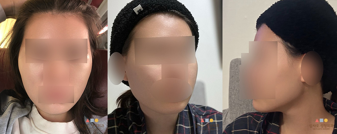 수술 전