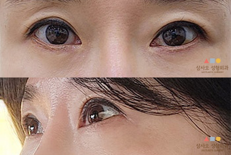 수술 후