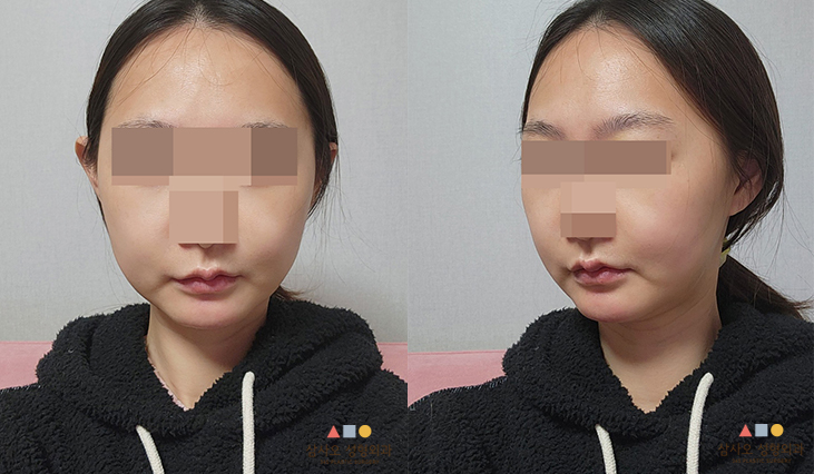 수술 후