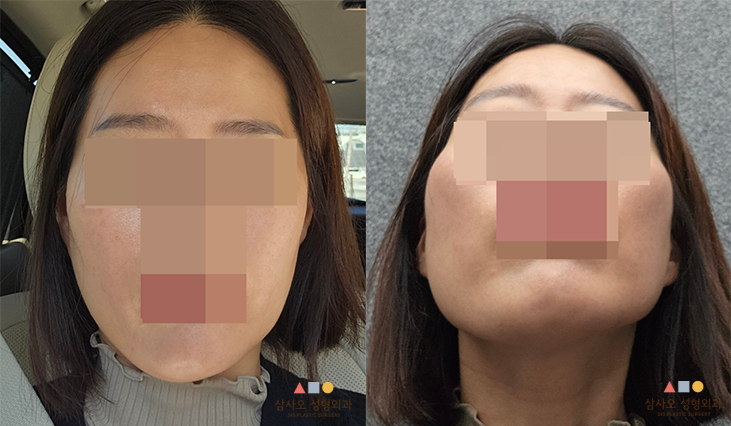 수술 전