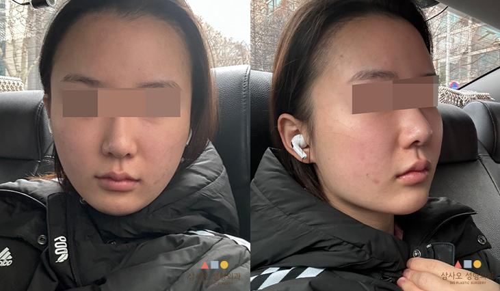 수술 전