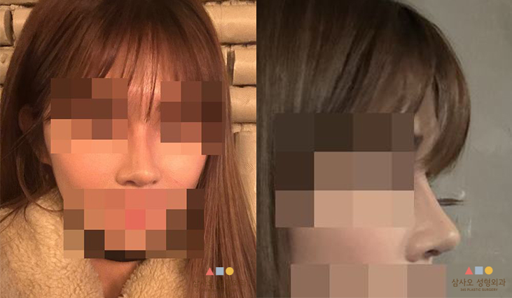 수술 후