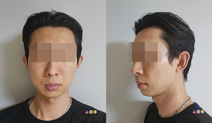 수술 후