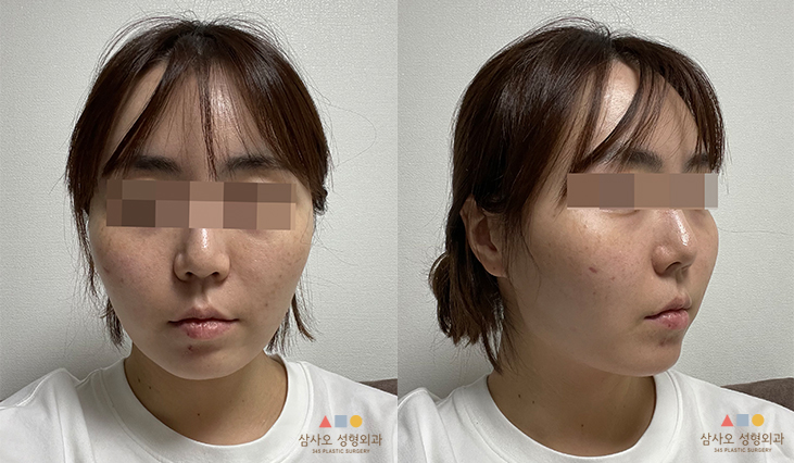 수술 전