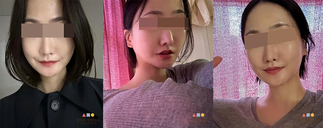 수술 후