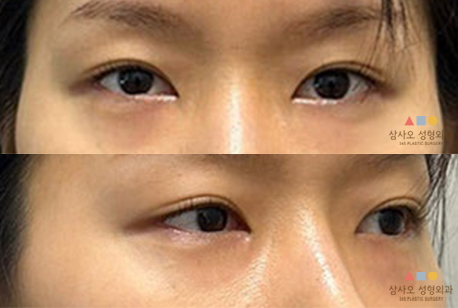 수술 전