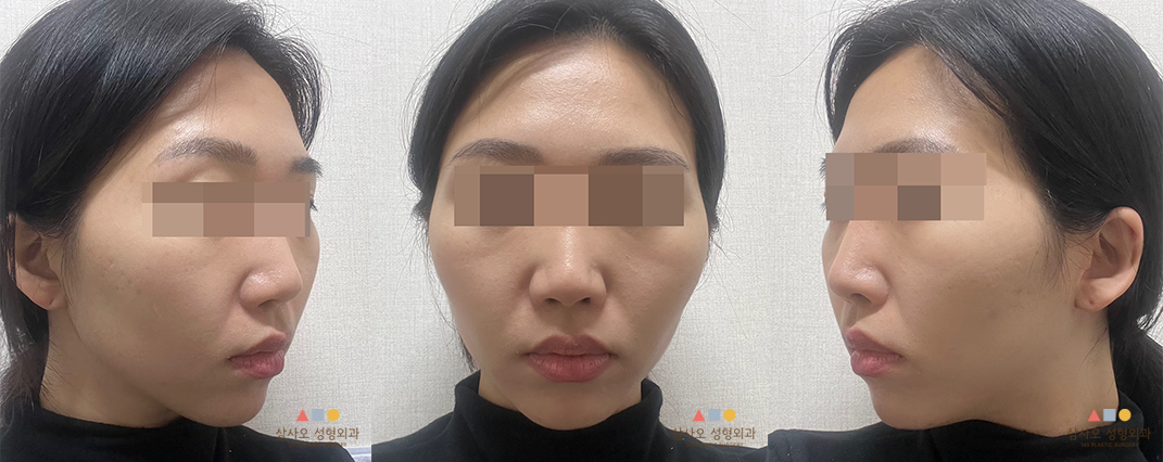 수술 전