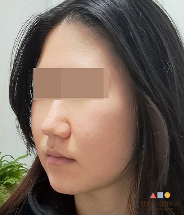 수술 후