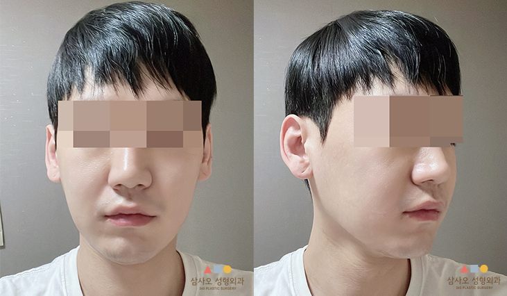 수술 후