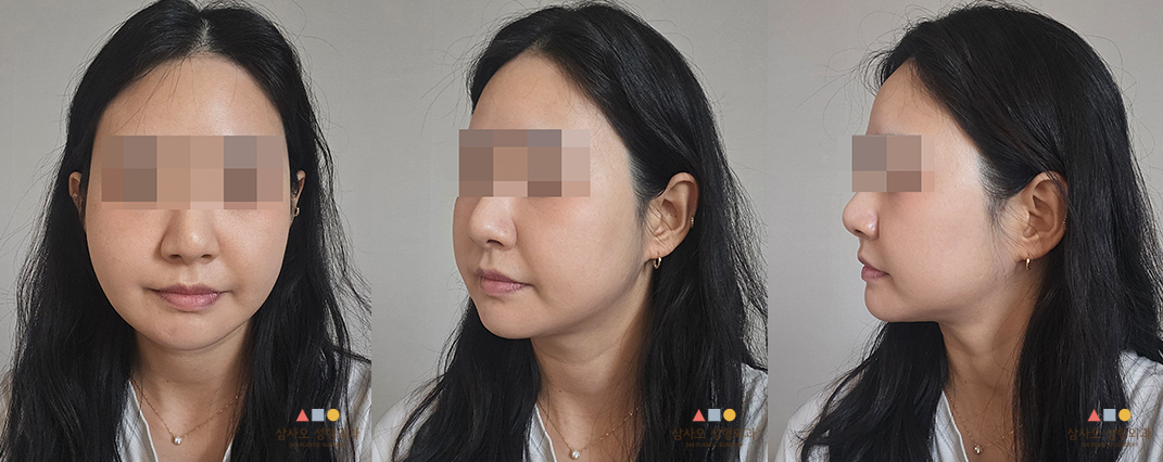 수술 후