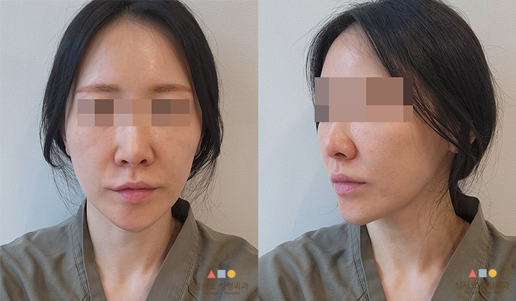 수술 전