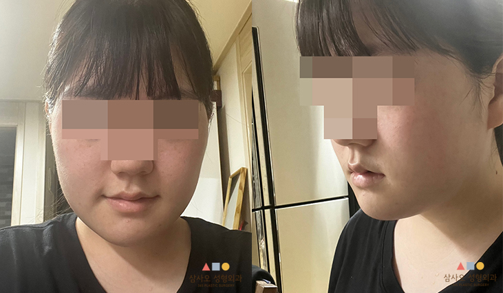 수술 후