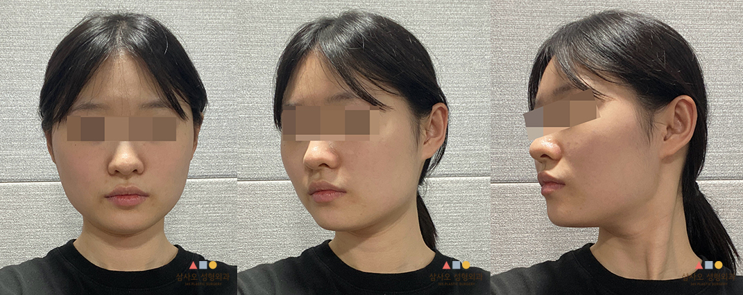 수술 전