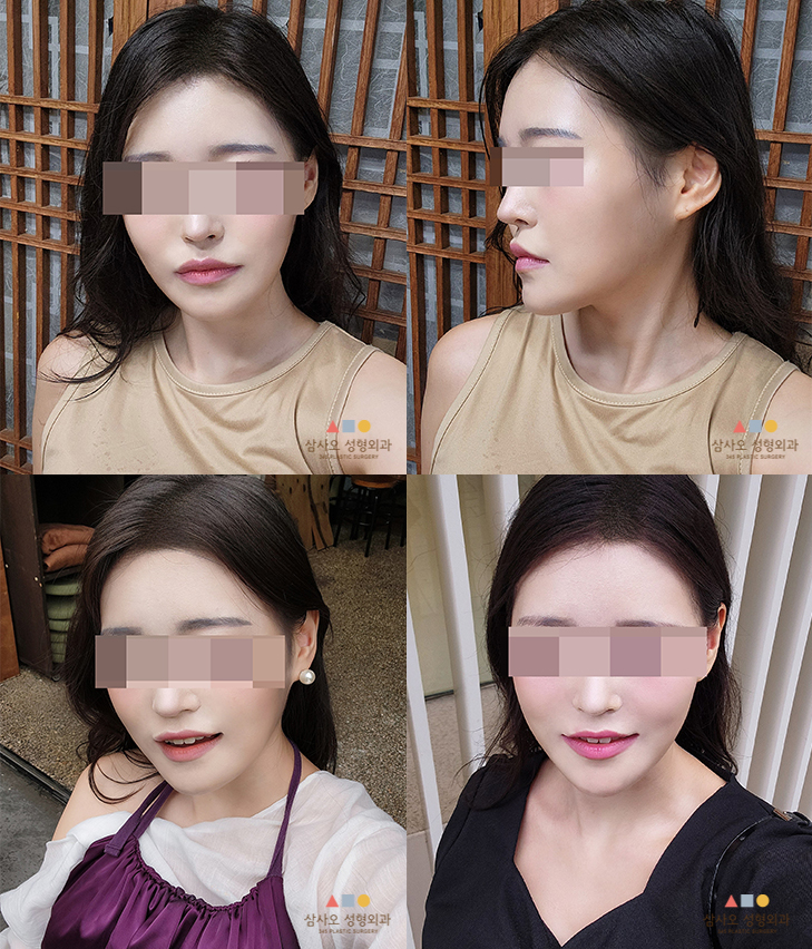 수술 후