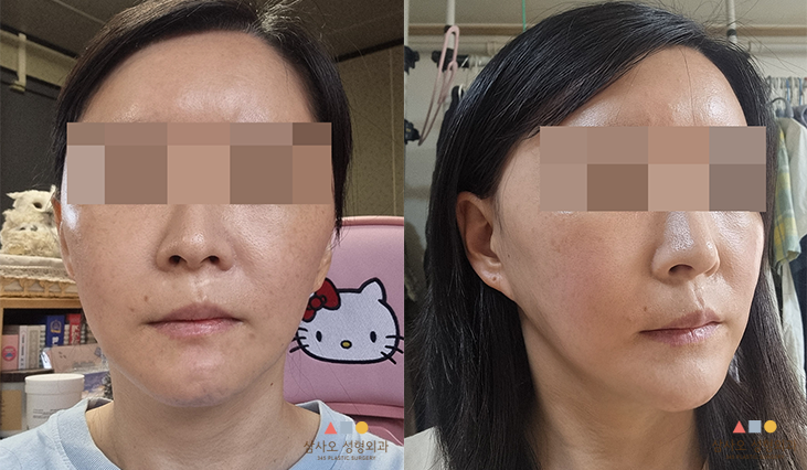 수술 후