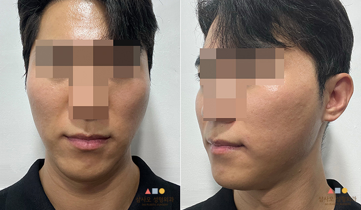 수술 전