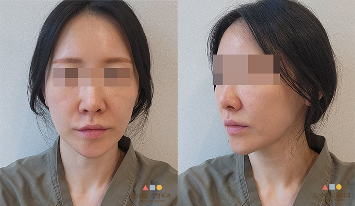 수술 전
