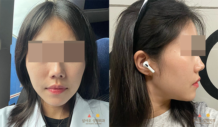 수술 후