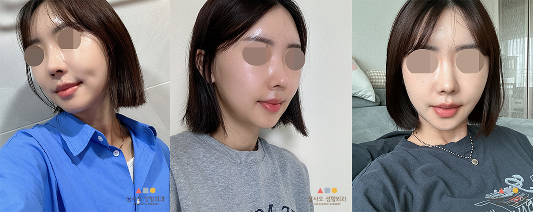 수술 후