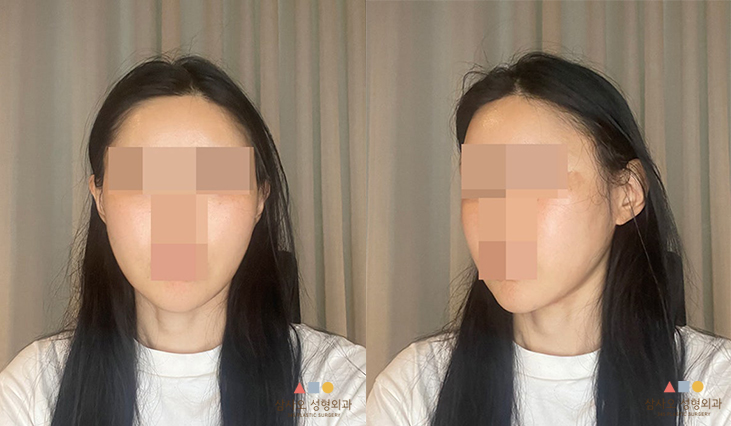 수술 후