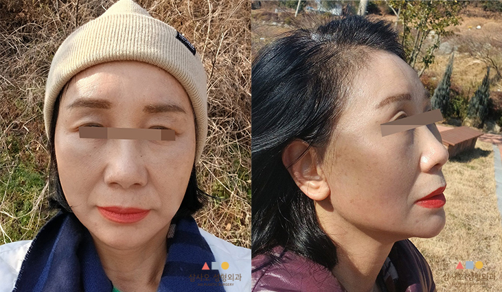 수술 후