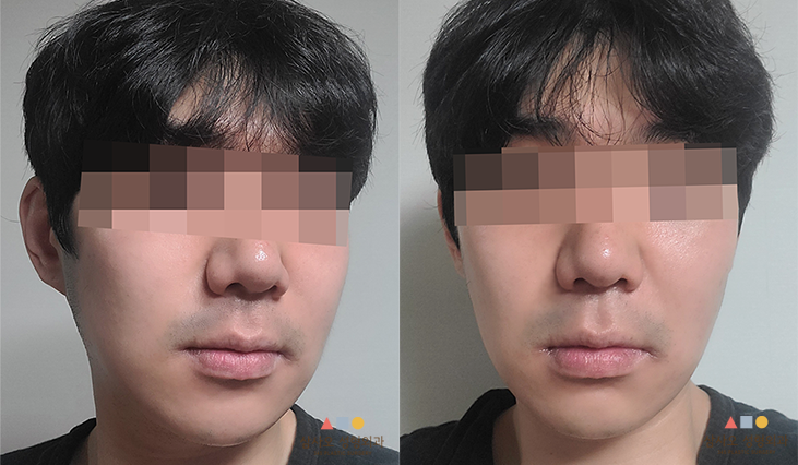 수술 후