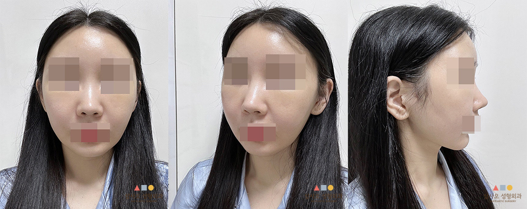 수술 후
