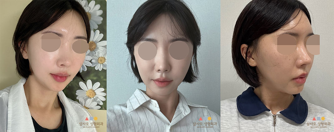 수술 후