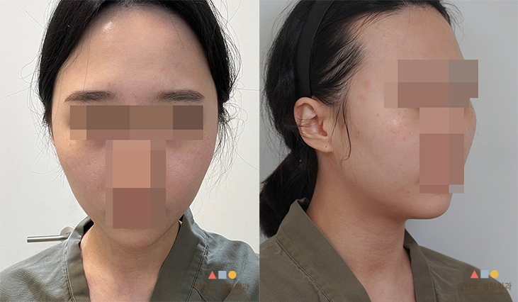수술 전