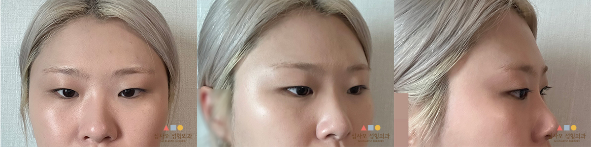 수술 전