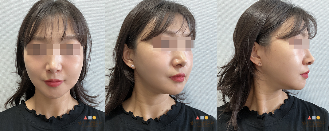 수술 후