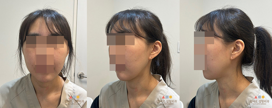 수술 전