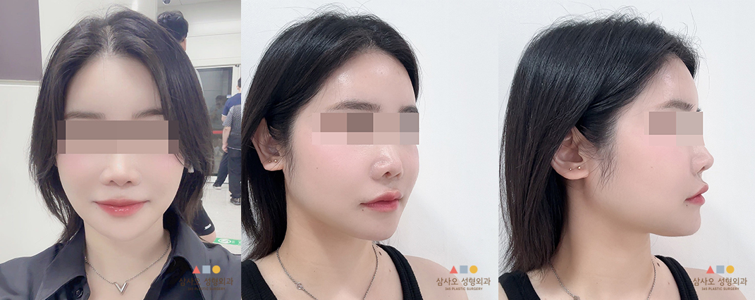 수술 후