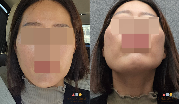 수술 전