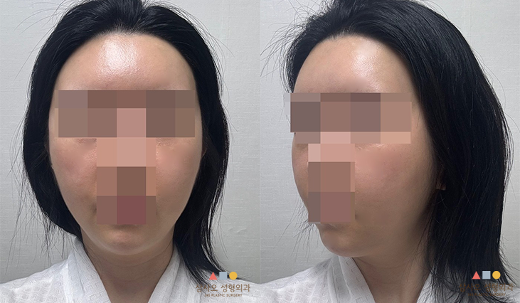 수술 후