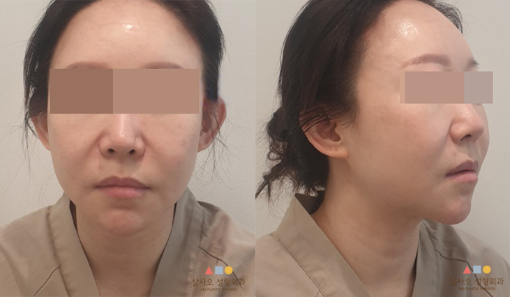 수술 전