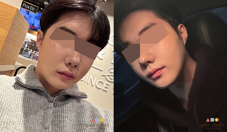 수술 후